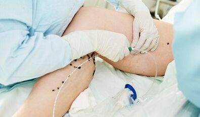 Metodi per il trattamento delle vene varicose sulle gambe nelle donne