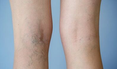 Segni di vene varicose sulle gambe nelle donne