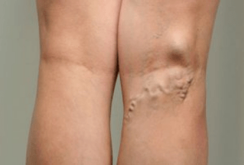 Diagnosi delle vene varicose nelle donne in gravidanza