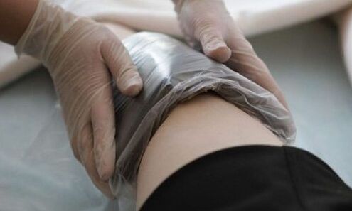 Trattamento delle vene varicose con impacchi