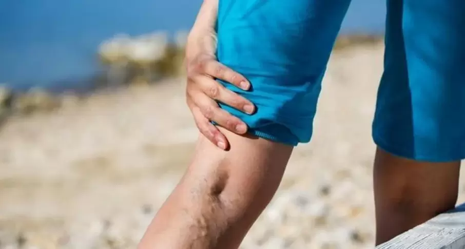 Vene varicose sulle gambe