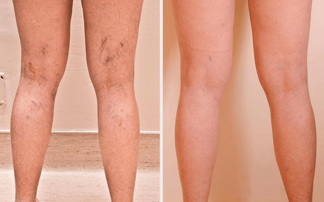 Gambe prima e dopo il trattamento per le vene varicose