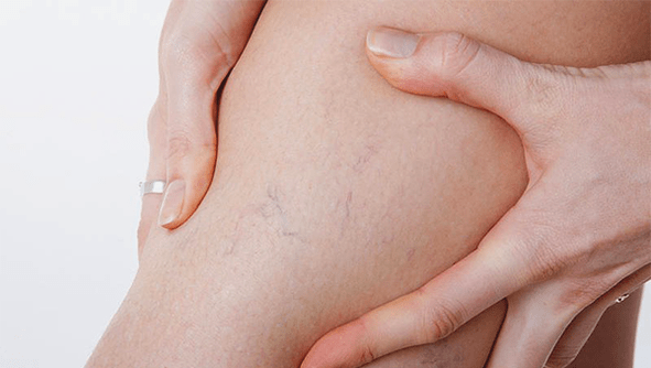 Vene varicose sulle gambe