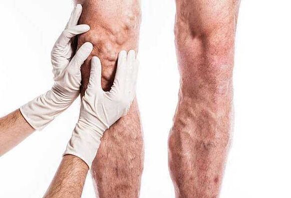 Palpazione delle vene varicose sulle gambe