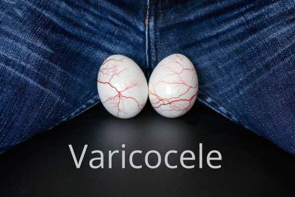 Varicocele – ingrossamento delle vene del cordone spermatico